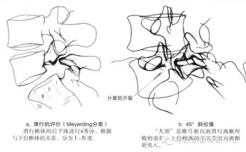 腰椎峡部裂能否认定工伤