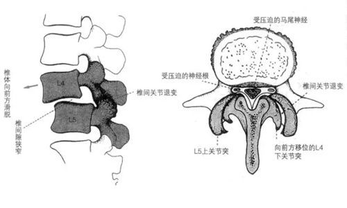 腰椎峡部裂能认定工伤吗