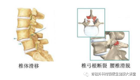 腰椎盘突出能认定工伤吗