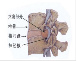 腰椎盘突出能认定工伤吗
