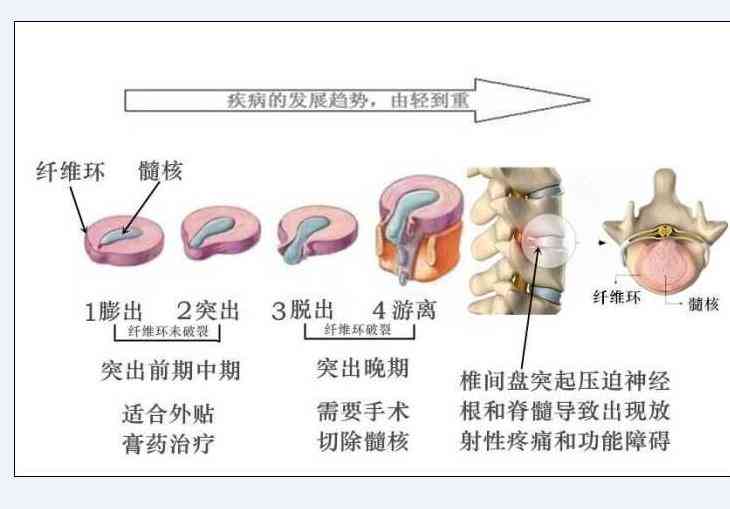 腰椎膨出怎么认定工伤