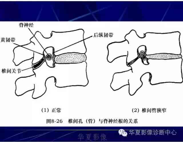 腰椎膨出怎么认定工伤