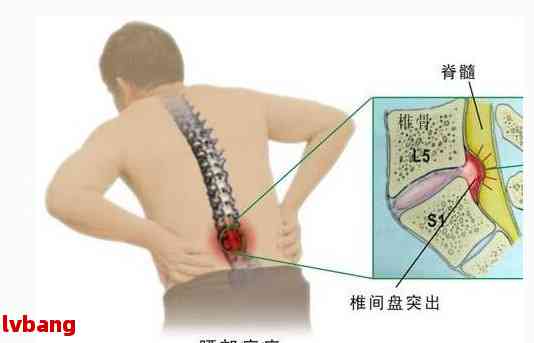 腰椎膨出能认定工伤吗