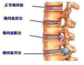腰椎间盘狭窄能认定工伤吗