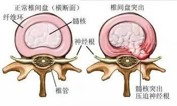 腰椎间盘突出症认定工伤