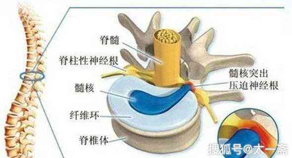 腰椎间盘突出能认定工伤么
