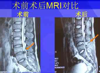 腰椎间突出症能认定工伤吗