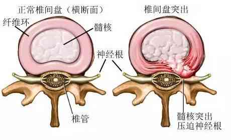 腰椎间突出症能认定工伤吗