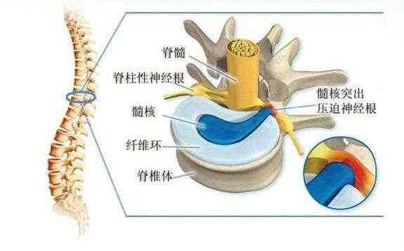 腰椎间突出认定工伤