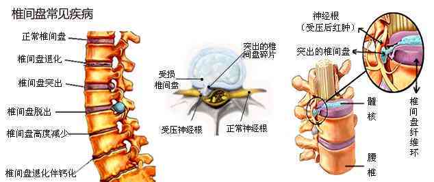 腰椎间突出认定工伤