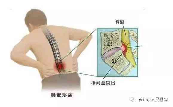 腰突复发怎样认定工伤