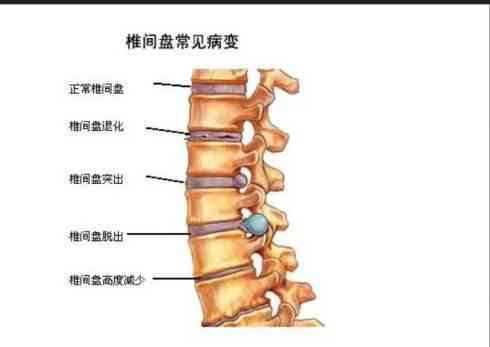 腰间盘突出症认定工伤流程