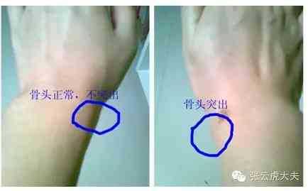 腱鞘囊肿能不能认定工伤