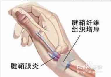 腱鞘囊肿能不能认定工伤