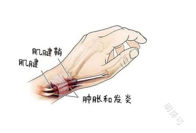 腱鞘炎可以认定工伤吗