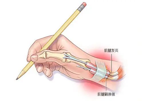 腱鞘炎能认定工伤