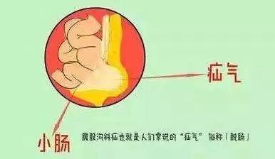 腹股沟斜疝能否认定工伤