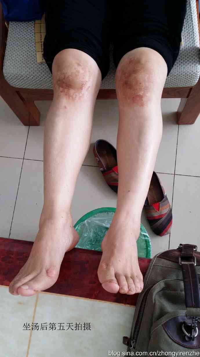 腿关节肿胀可以认定工伤吗