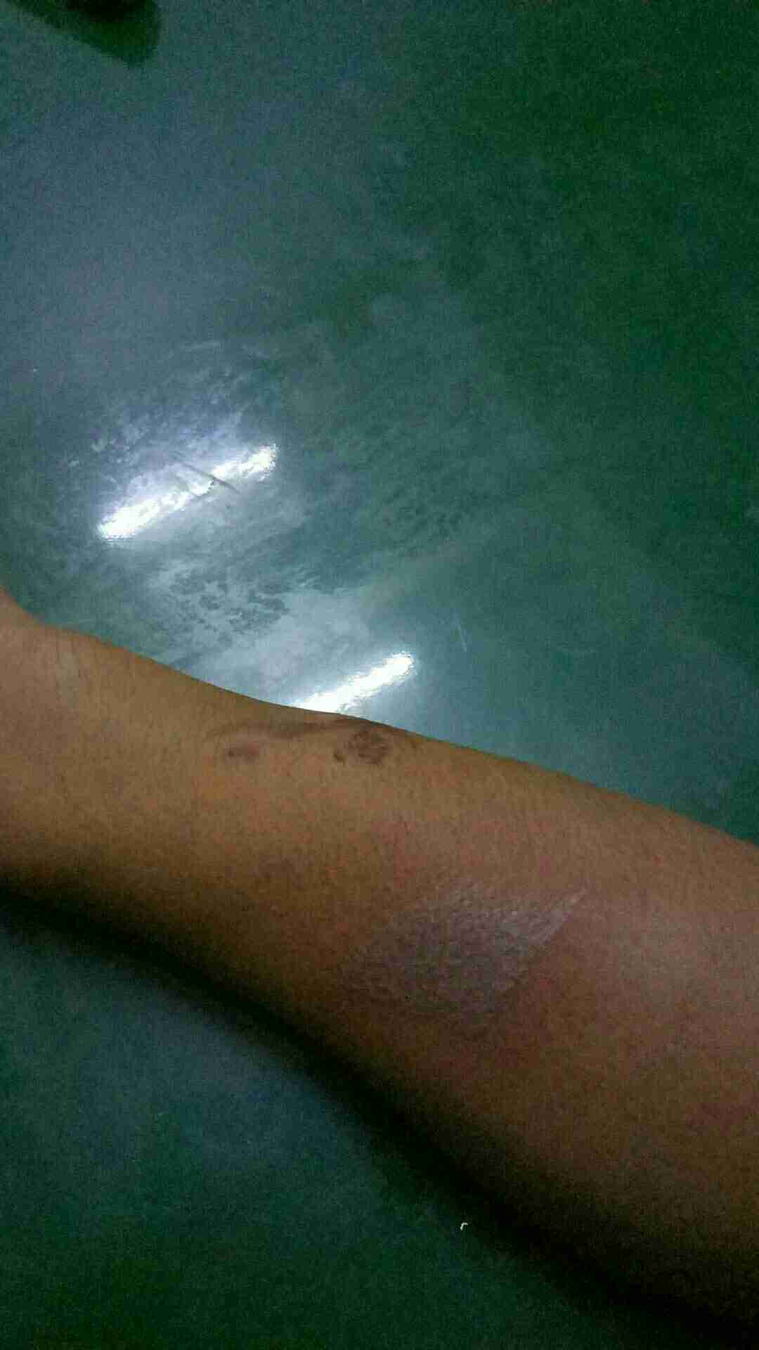 腿碰到肿了能认定工伤嘛