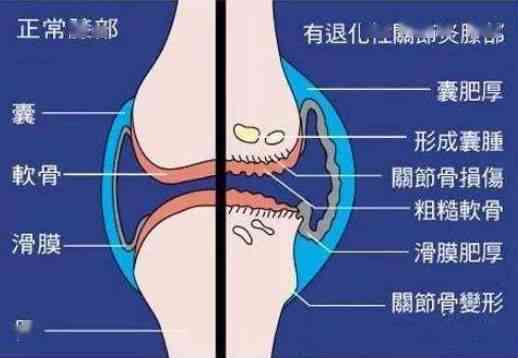 膝关节积液能认定工伤吗