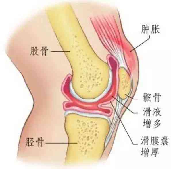 膝积液能认定工伤么
