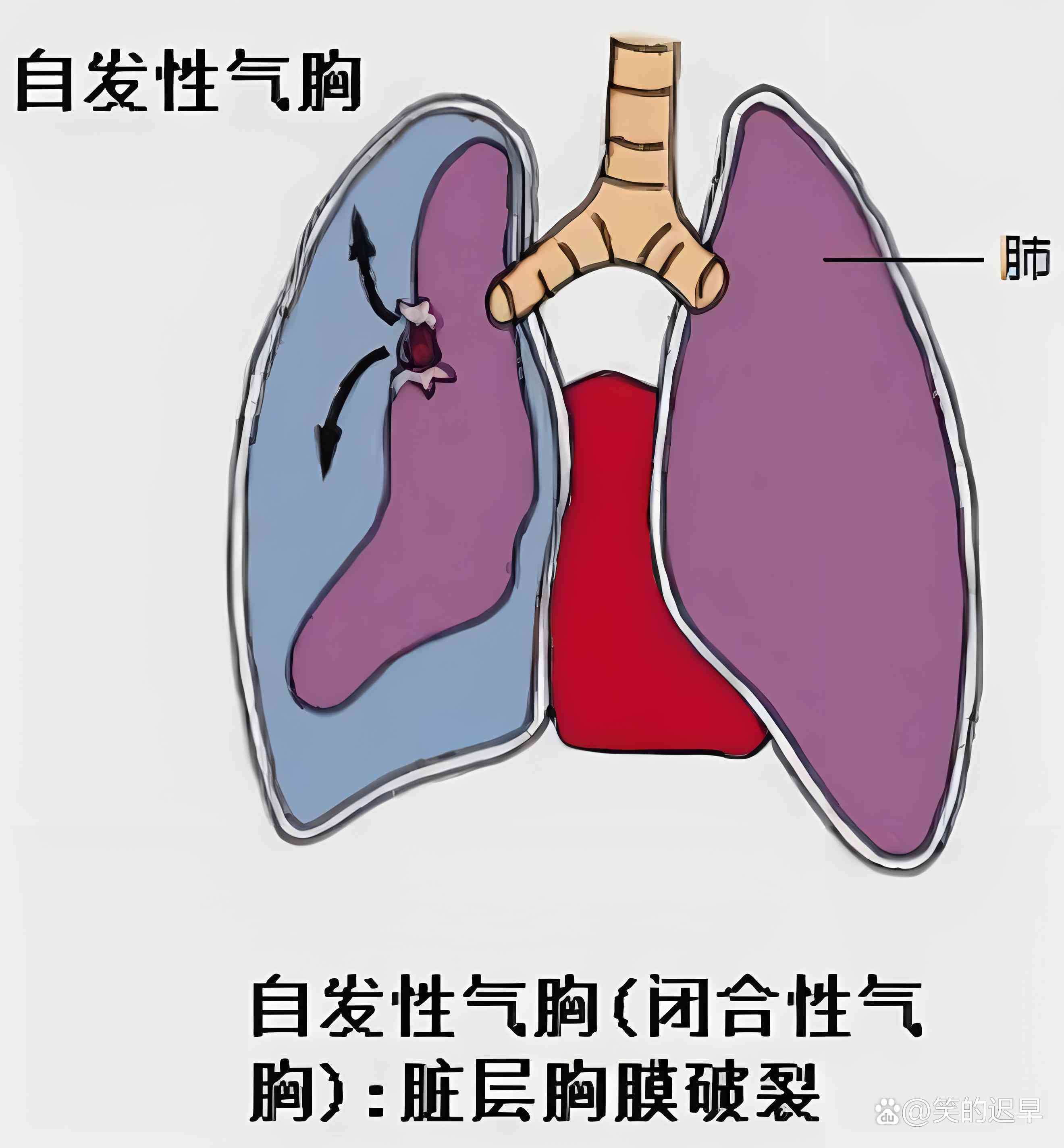 自发性气胸可以认定工伤吗