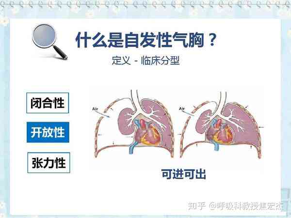自发性气胸可以认定工伤吗