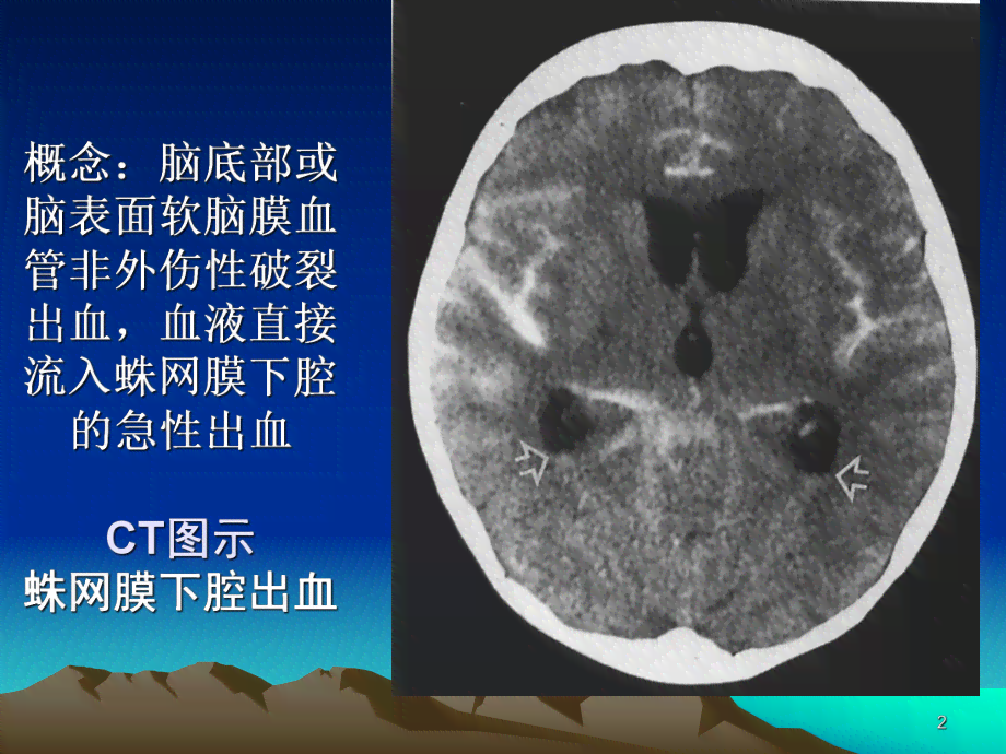 蛛网膜下腔出血认定工伤