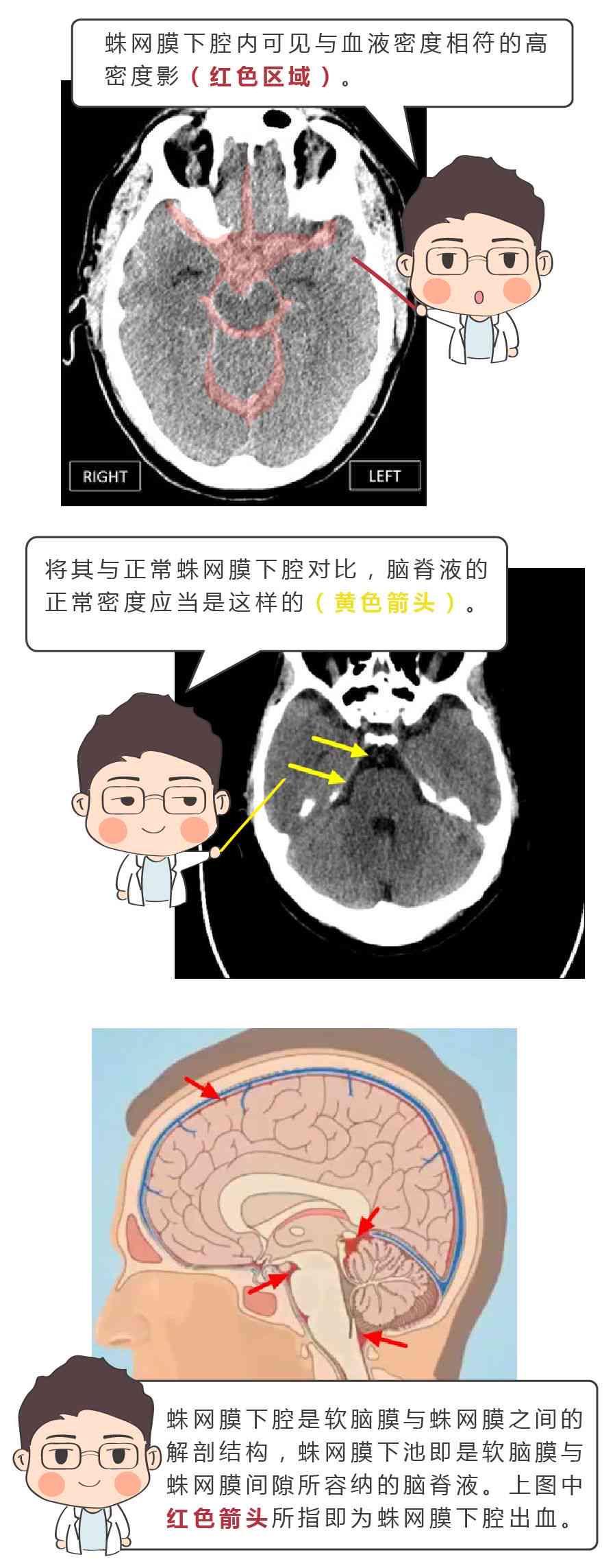蛛网膜下腔出血认定工伤