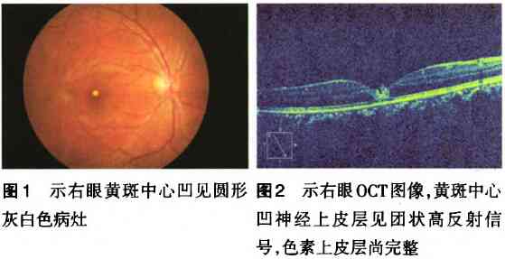 视网膜损伤怎么认定工伤