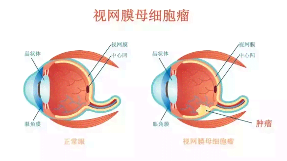 视网膜破裂可以认定工伤吗