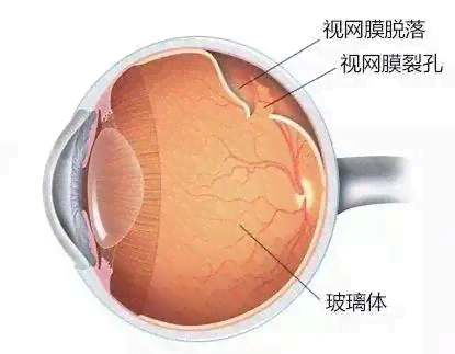 视网膜脱离可以认定工伤吗