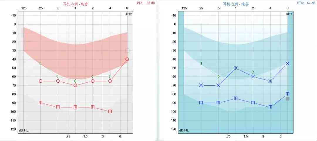 纯音听阈测试报告ai