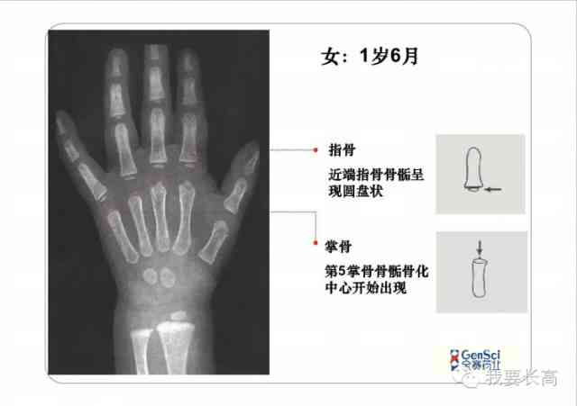ai骨龄报告怎么看