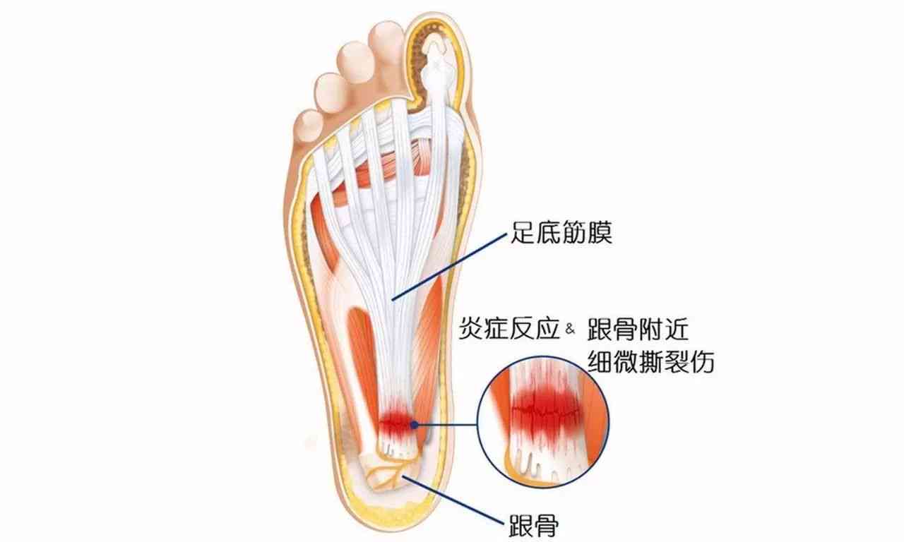 足底筋膜炎可认定工伤