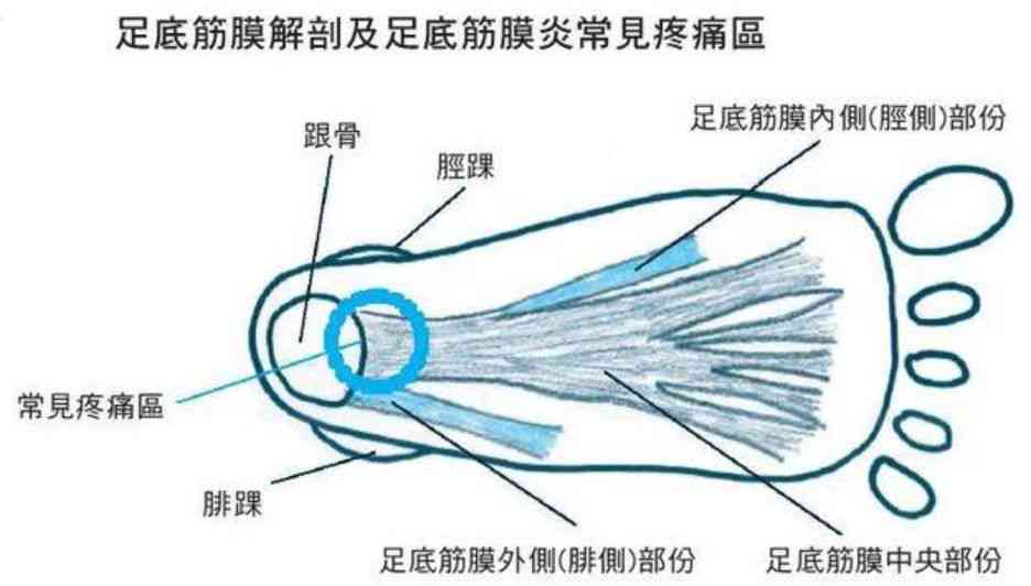 足底筋膜炎可认定工伤