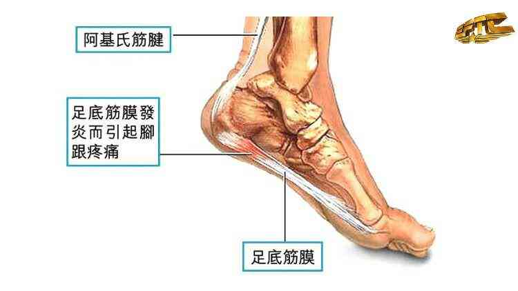 足筋膜炎可以认定工伤