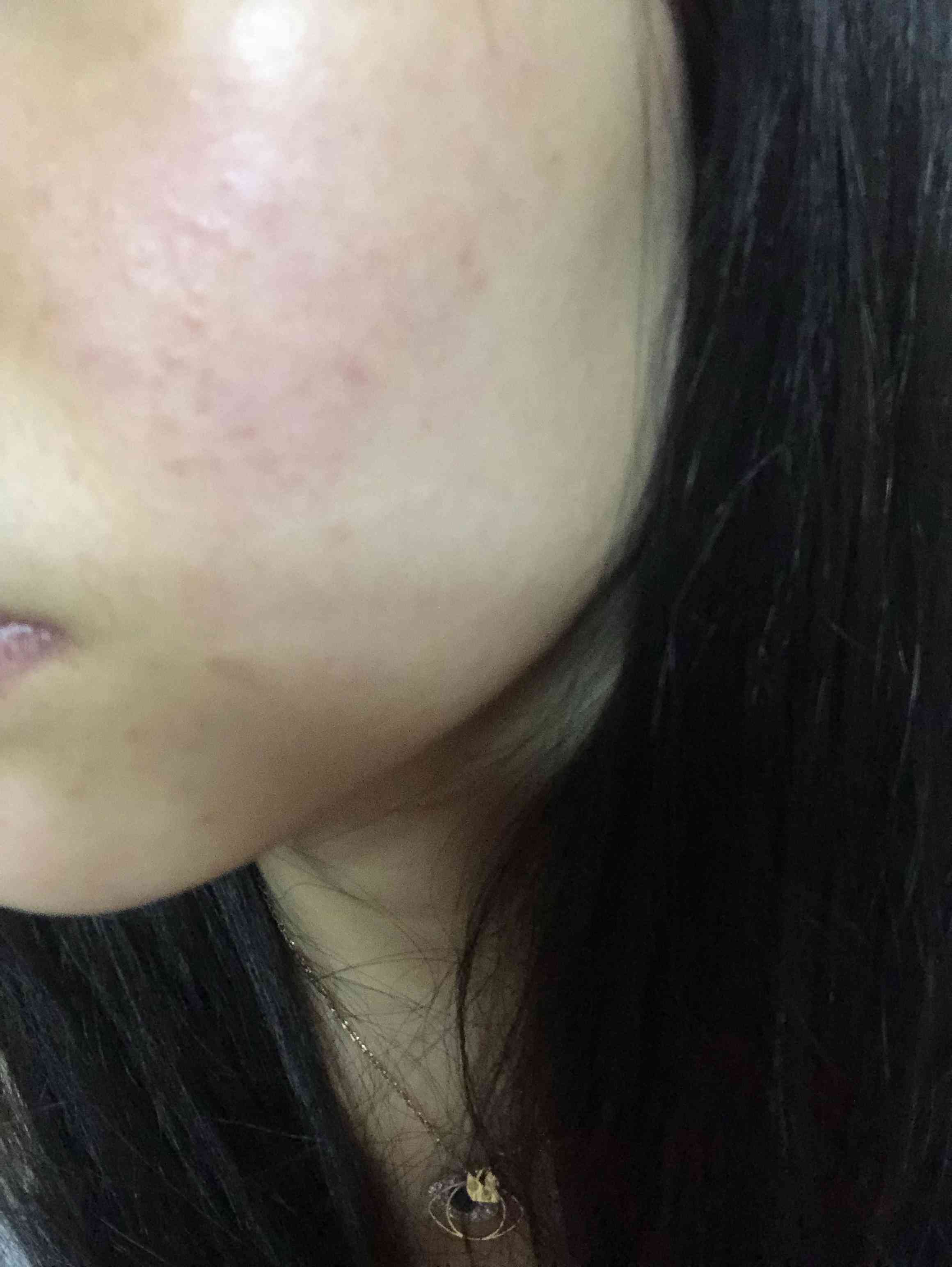 过敏性皮炎可以认定工伤吗