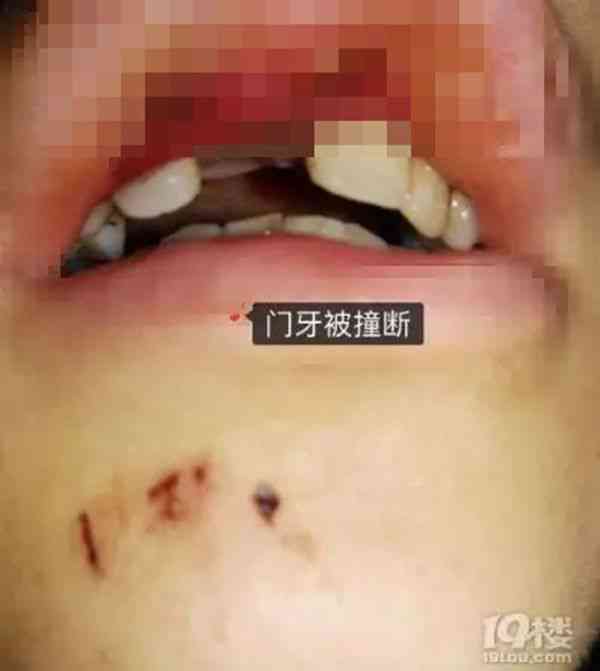 门牙磕掉了认定工伤