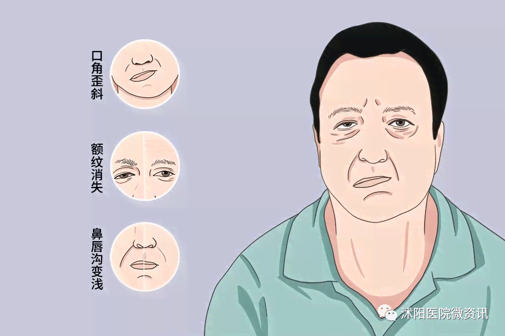 面神经炎能不能认定工伤