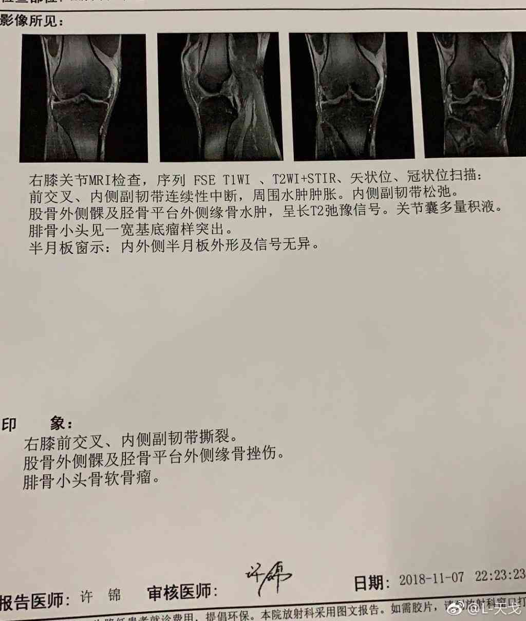韧带撕裂能认定工伤等级嘛