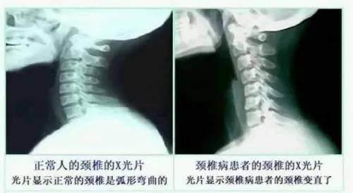颈椎曲度反能认定工伤吗