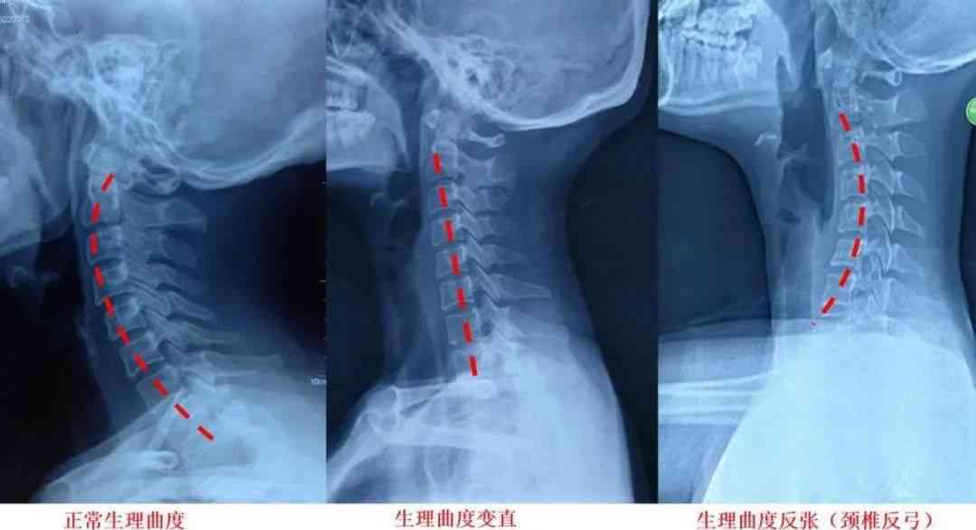 颈椎曲度反能认定工伤吗