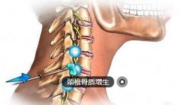 颈椎骨刺可以认定工伤吗