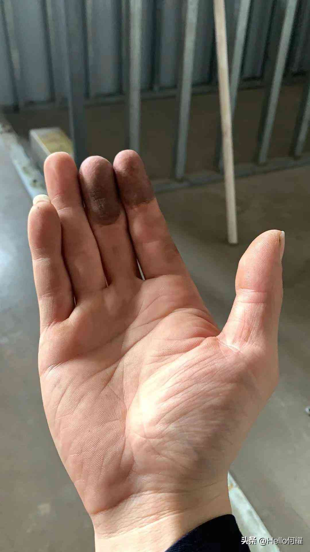 骨头断了怎么认定工伤等级