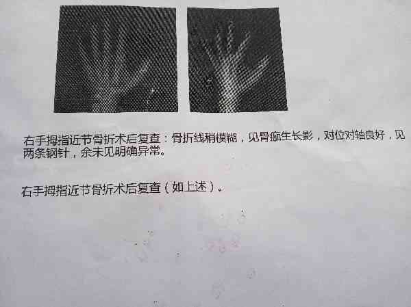 骨裂可以认定工伤等级吗