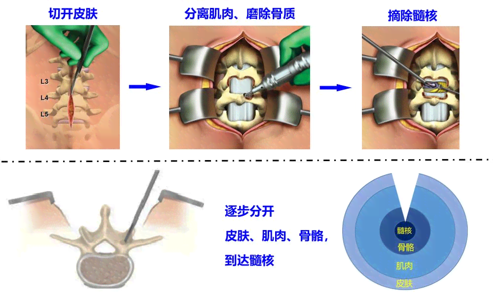 髓核摘除能认定工伤吗