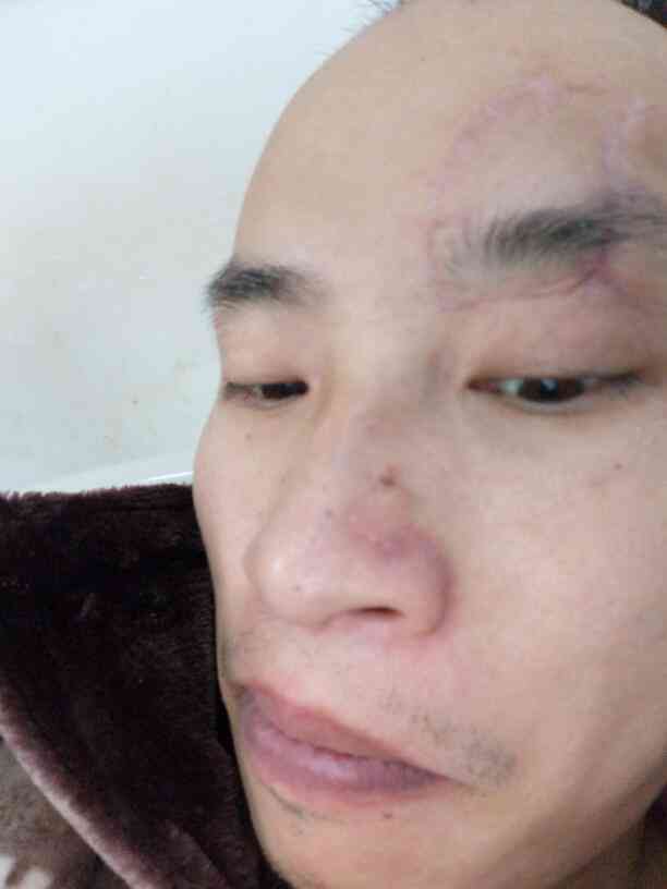 鼻缺损认定工伤几级伤残
