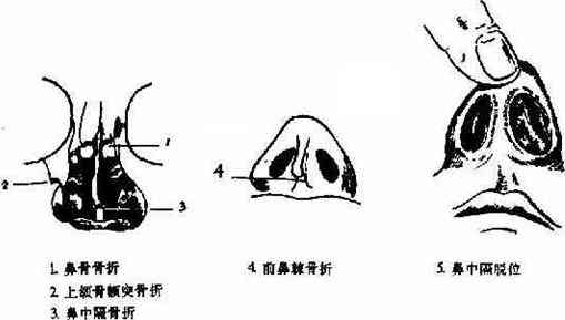 鼻缺损认定工伤几级伤残