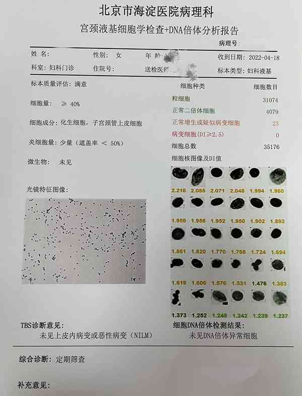 ai宫颈癌筛查报告多久出来